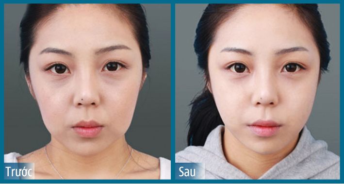 máy octoline tre hoa da.jpg (142 KB)